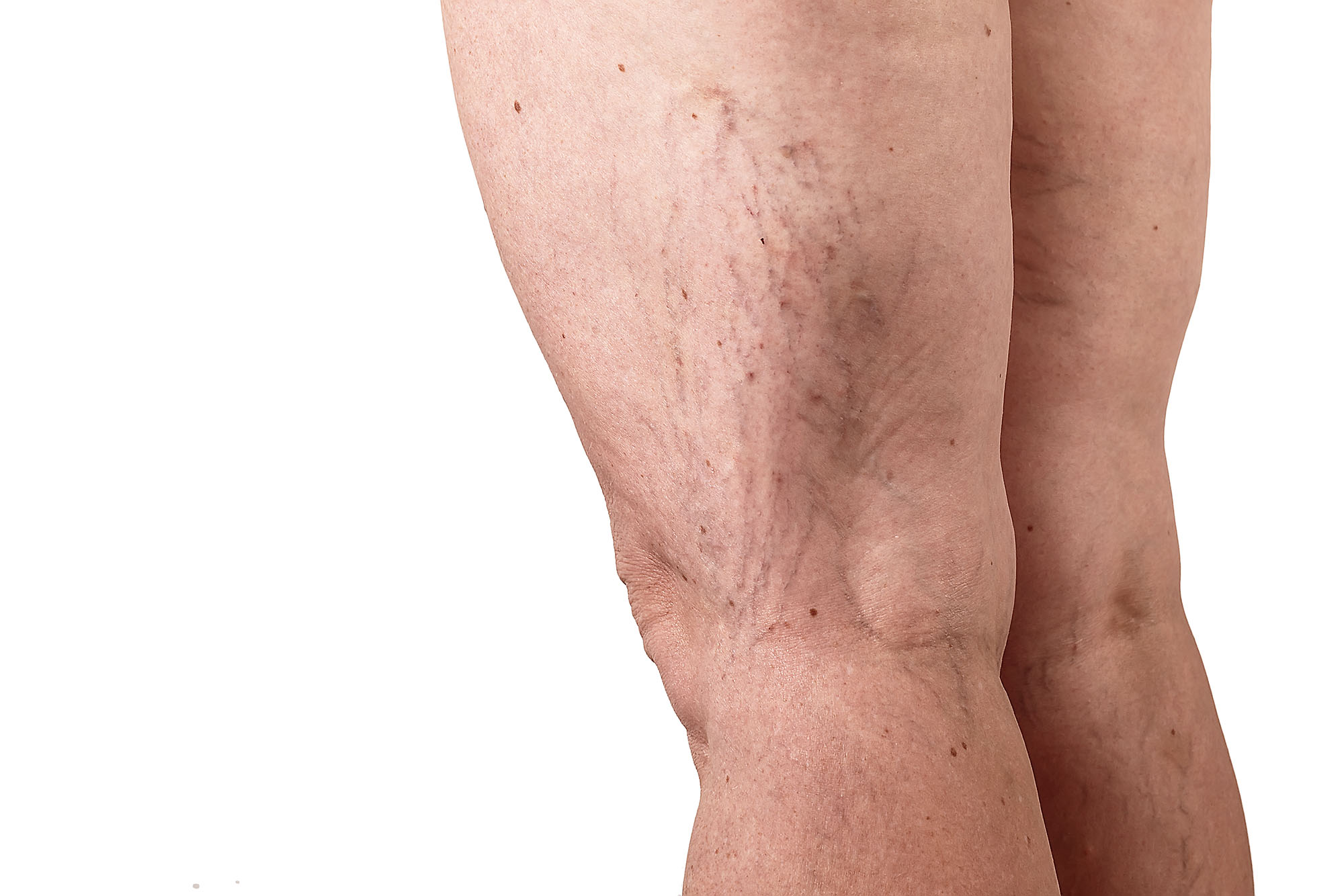 the disease varicose veins on a legs